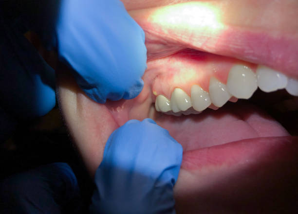 Best Emergency Gum Treatment in Atascocita, TX