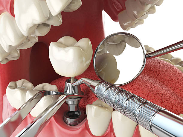 Best Emergency Tooth Extraction in Atascocita, TX